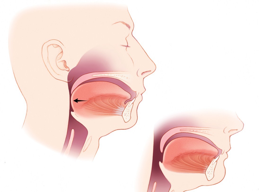 Causes of Snoring and Sleep Apnea