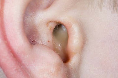 Ear Discharge Symptoms